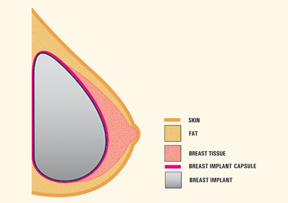 Breast Implant Capsule